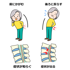 脊柱管狭窄症かがむ