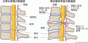 脊柱管狭窄症の脊椎断面